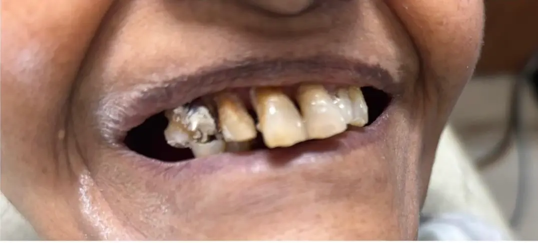 Before dental case 1