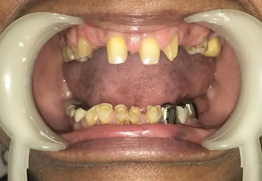 Before dental case 3