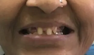 Before dental case 4